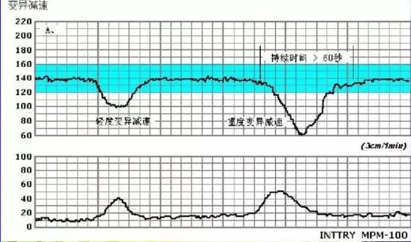 胎心监护胎心减速的三种曲线