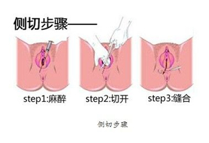 什么是顺产侧切 每个产妇都要侧切吗?分娩方式