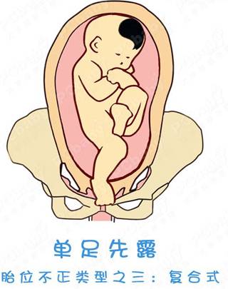 胎位不正怎么办？纠正胎位的正方法（图）