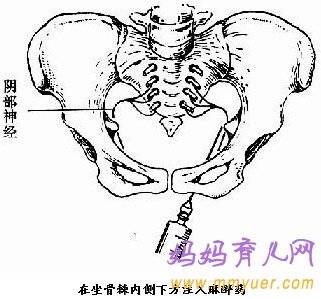 顺产侧切伤口护理方法及注意事项（图片）