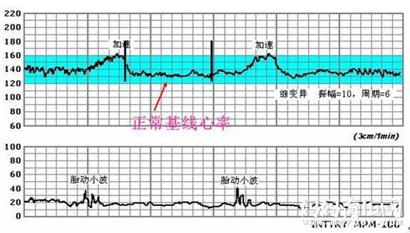 不知道胎心监护图怎么看？教你简单几步看懂胎心监护图