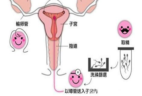 子宫内膜抗体阳性是怎么引起的