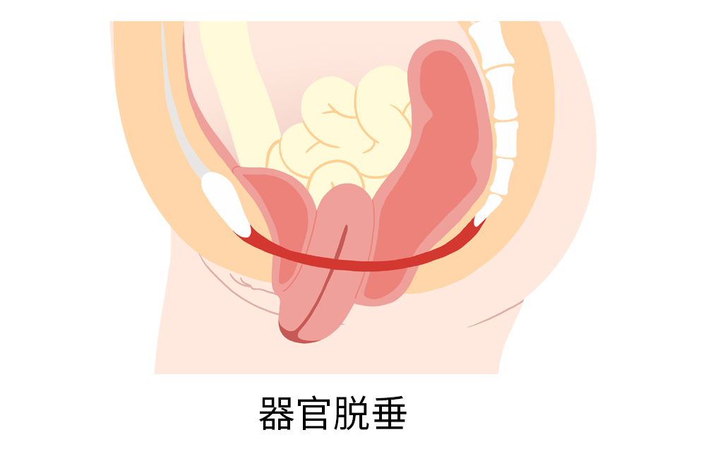 盆腔器官脱垂.jpg