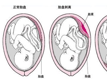 什么是前置胎盘以及它的种类