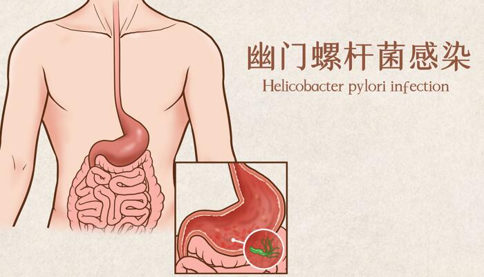 我国超一半人携带幽门螺杆菌 感染幽门螺杆菌可以根治吗