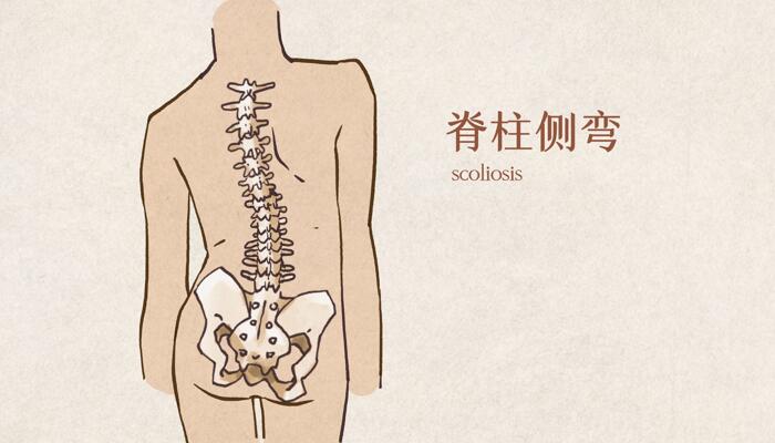 脊柱侧弯已纳入学生体检 1个动作自查是否脊柱侧弯